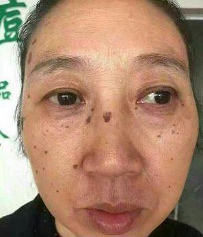 去老年斑的簡單方法，重拾肌膚光彩的秘訣，去老年斑秘籍，重拾肌膚光彩的簡易方法