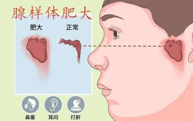 腺樣體肥大能自愈嗎？——深度解析與理解，腺樣體肥大能否自愈？全面深度解析