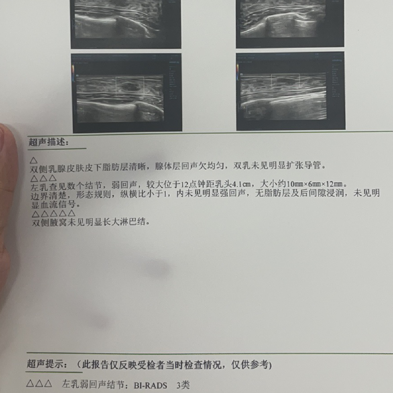 乳腺結(jié)節(jié)3類嚴(yán)重嗎？解讀乳腺健康，讓你了解真相，乳腺結(jié)節(jié)3類嚴(yán)重嗎？解讀乳腺健康真相