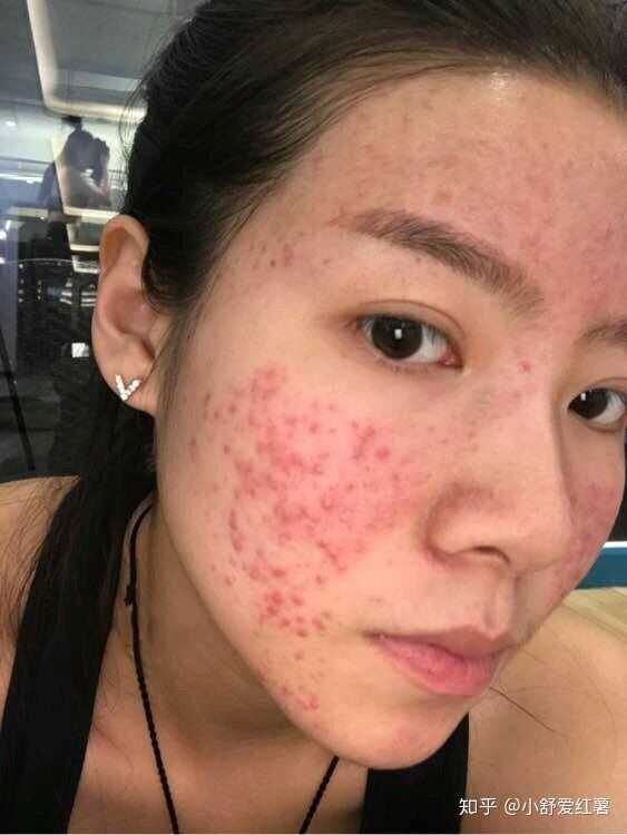 如何有效去除臉上的痘印——全方位指南，全方位指南，如何有效去除臉上痘印的方法