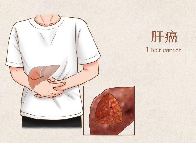 肝癌一般三處痛，癥狀解析與應(yīng)對(duì)策略，肝癌癥狀解析，疼痛位置、應(yīng)對(duì)策略及三處痛詳解