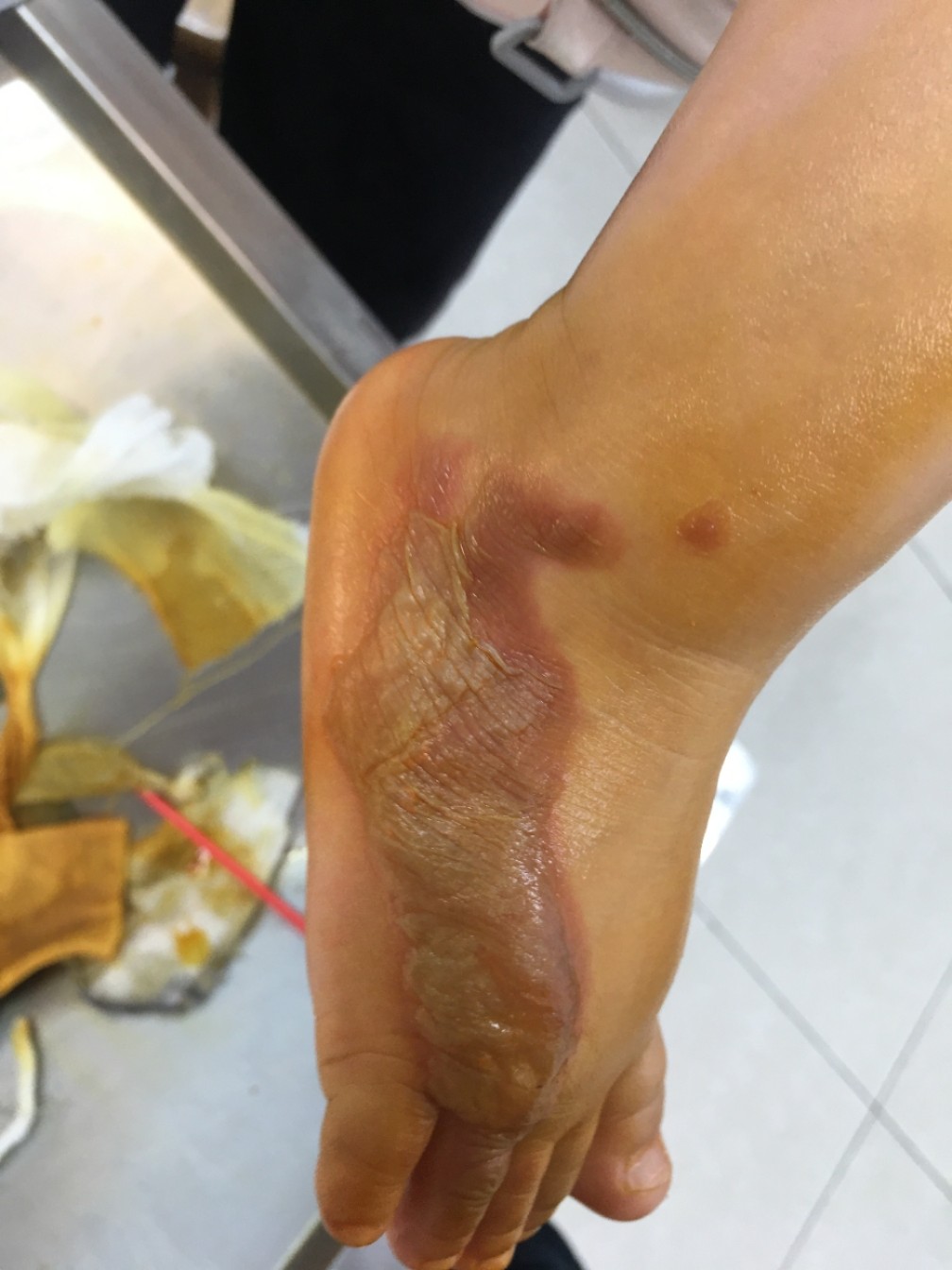燙傷后如何選用最佳藥膏，避免留下疤痕，燙傷藥膏選擇與疤痕預防，燙傷后的最佳護理指南