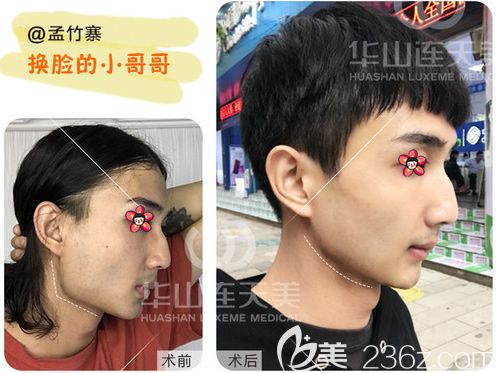 削顴骨手術費用詳解，手術費用大概要多少錢？，削顴骨手術費用詳解，手術費用及預算指南
