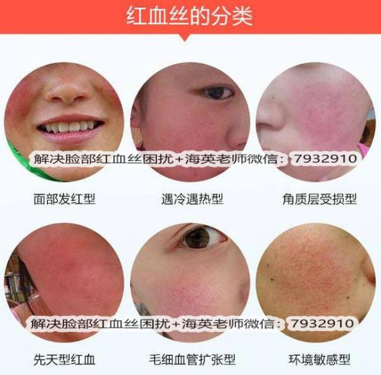 臉上出現(xiàn)紅血絲怎么治療，全面解析有效方法，臉上紅血絲全面解析與有效治療方法