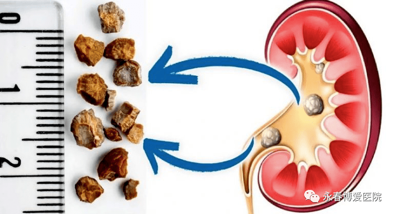 腎結(jié)石的最好治療方法有哪些，腎結(jié)石的最佳治療方法介紹