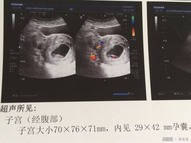 有卵黃囊基本就穩(wěn)了，早期妊娠的穩(wěn)固跡象與注意事項，早期妊娠的穩(wěn)固跡象，卵黃囊出現后的穩(wěn)定與注意事項
