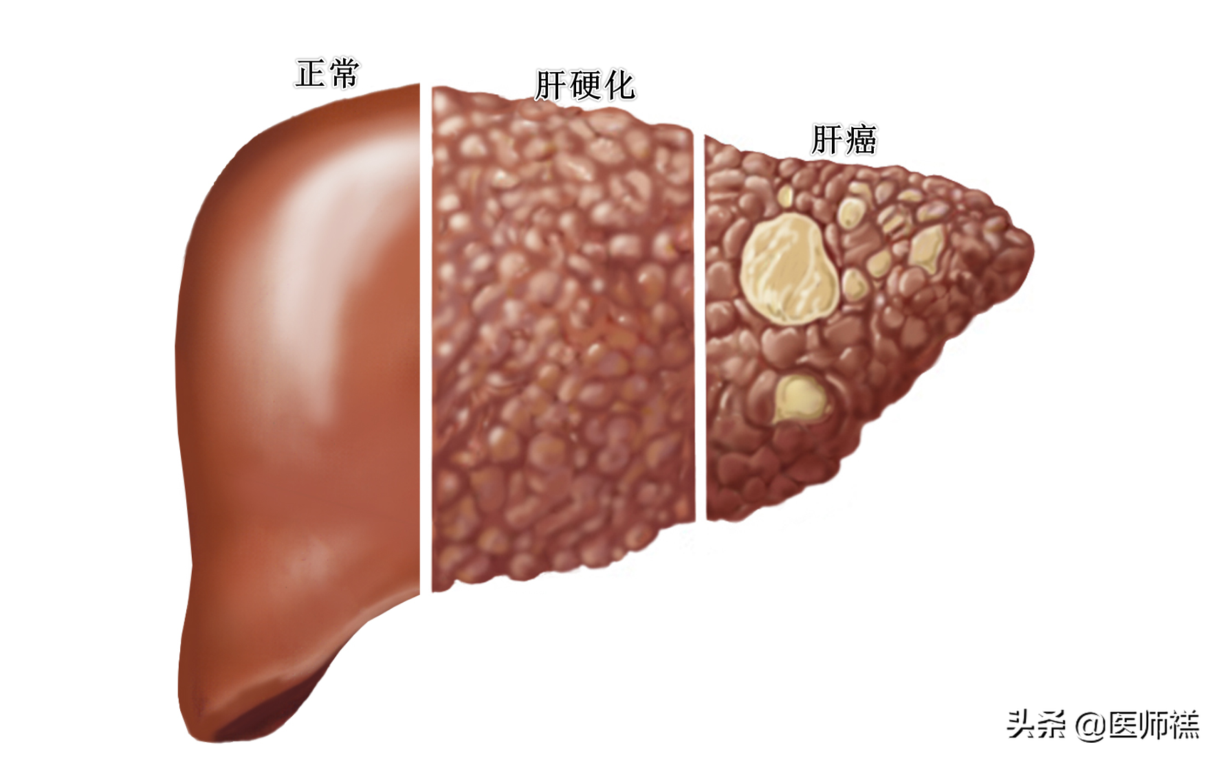 早期硬化的肝能治愈嗎，全面解析與希望，早期肝硬化能否治愈，全面解析與預(yù)后展望