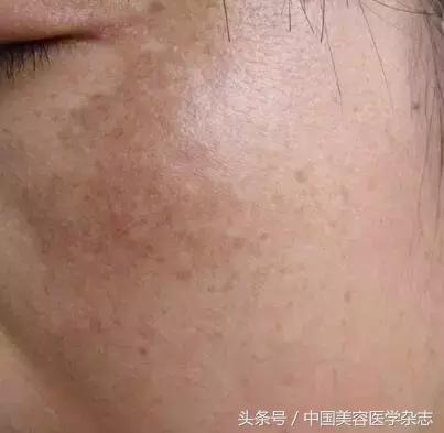 黃褐斑怎么治療最有效，全面解析最佳療法，全面解析黃褐斑最佳治療方法，最有效的療法選擇