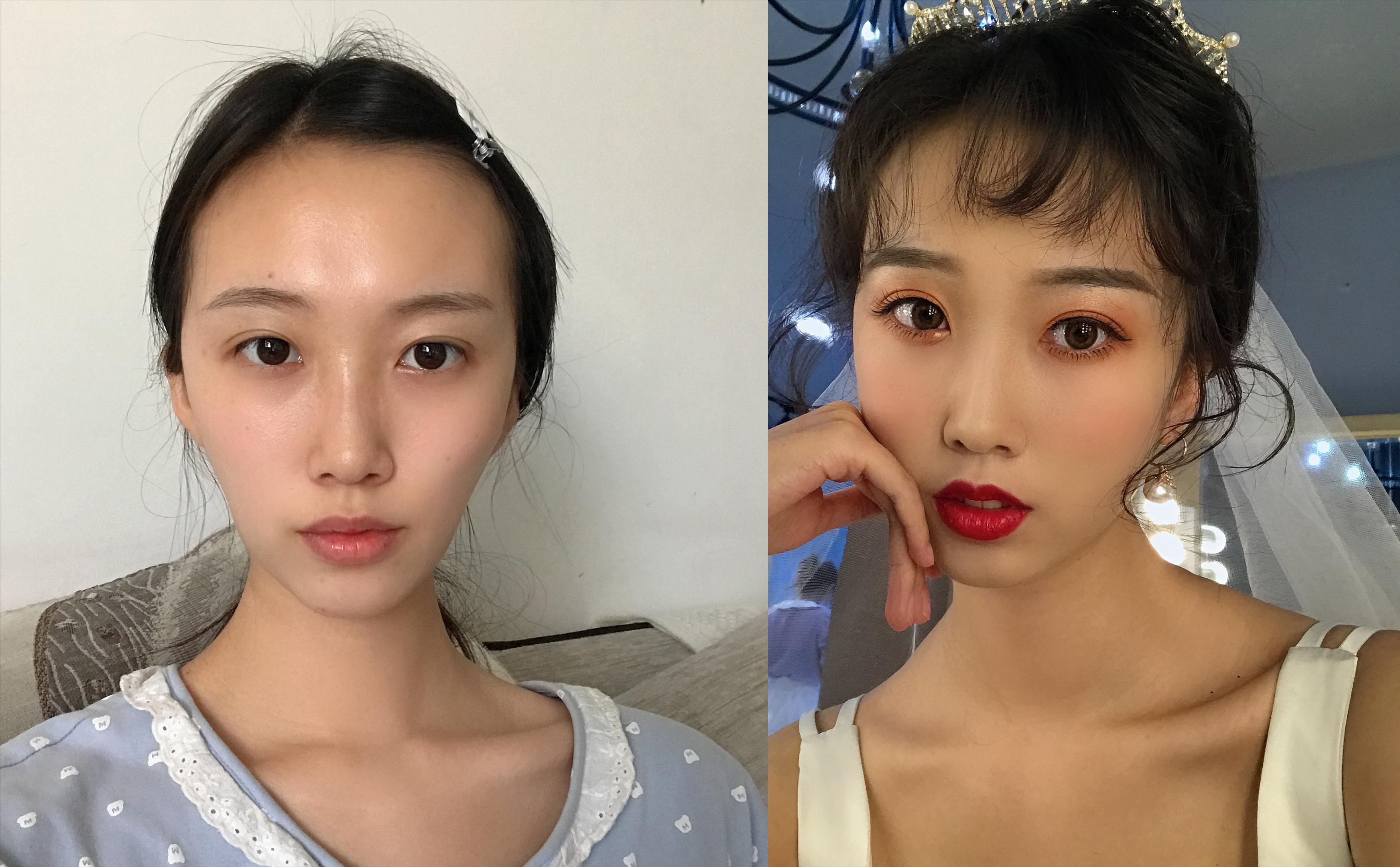 自體填充脂肪，利弊分析，自體脂肪填充的利弊分析