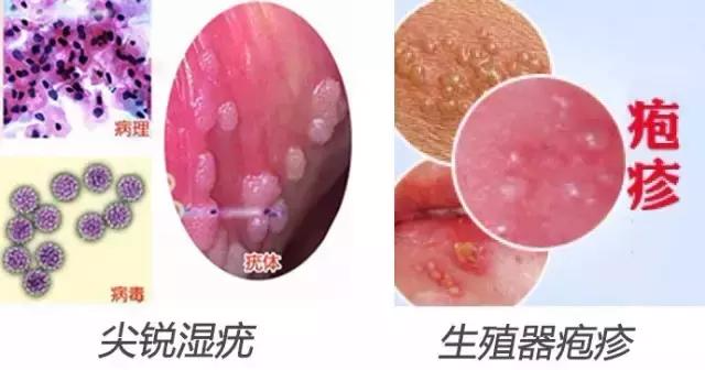 男性尖銳濕疣初期圖片及其相關(guān)解析，男性尖銳濕疣初期圖片及癥狀解析