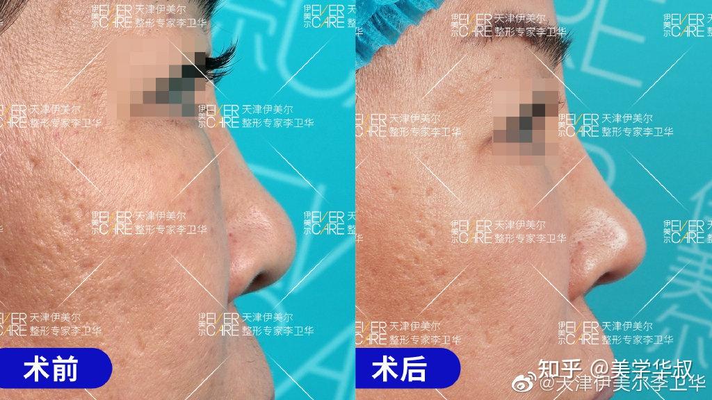 捏鼻三年，鼻頭變大——深度解析捏鼻子對(duì)鼻子的影響及應(yīng)對(duì)之策，捏鼻三年的影響，鼻頭變大原因解析與應(yīng)對(duì)之策