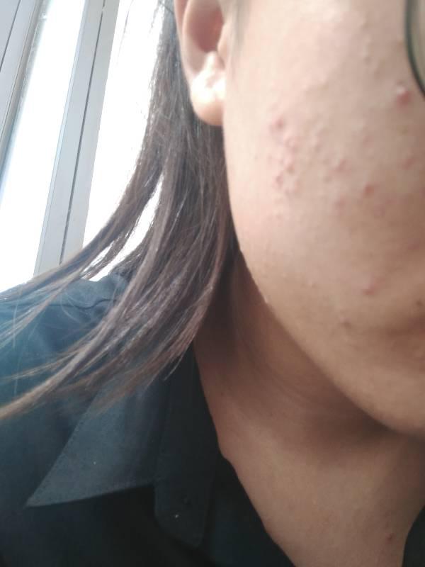 閉口粉刺的樣子與圖片解析，閉口粉刺詳解，圖片解析及其外觀(guān)特征