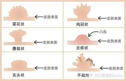 女性如何自己判斷真假尖銳濕疣？，女性如何自主辨別真假尖銳濕疣？
