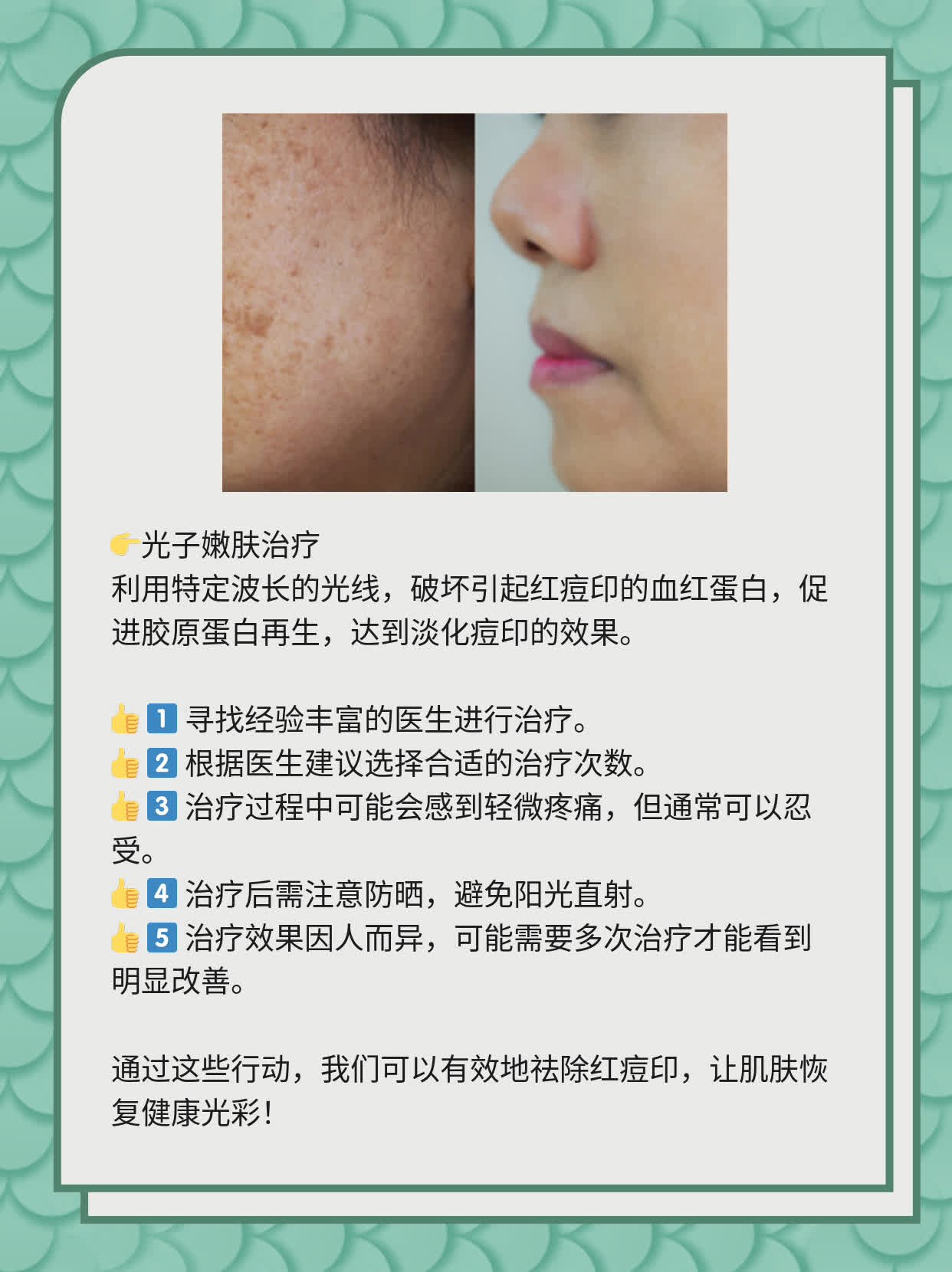 如何有效去除紅痘印，一站式解決方案，一站式解決紅痘印問(wèn)題，有效去除方法大全