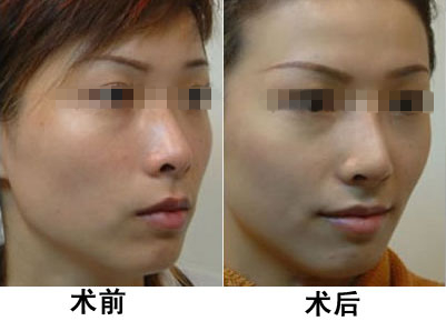 光子嫩膚做一次有效嗎？深入了解光子嫩膚的效果與過程，光子嫩膚效果與過程解析，做一次是否有效？