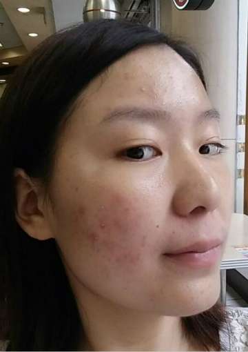 如何有效去除臉上痘痘——多種方法助您重拾肌膚光彩，多種方法助您有效去除臉部痘痘，重拾肌膚光彩