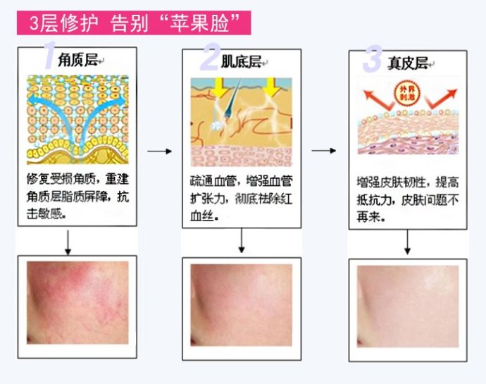 治療紅血絲的最佳方法，治療紅血絲的最佳方法簡述