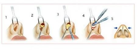 微調(diào)鼻子需要多少錢，全面解析費(fèi)用因素與注意事項(xiàng)，微調(diào)鼻子費(fèi)用全解析，費(fèi)用因素與注意事項(xiàng)，需要多少錢？