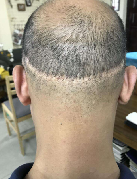 植發(fā)效果的持久性，能否長(zhǎng)期維持與多種因素相關(guān)，植發(fā)效果的持久性與多種因素關(guān)聯(lián)，長(zhǎng)期維持探討