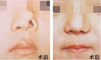 鼻整形手術(shù)費(fèi)用詳解，多少錢？一切因素告訴你！，鼻整形手術(shù)費(fèi)用全面解析，價(jià)格因素一網(wǎng)打盡！