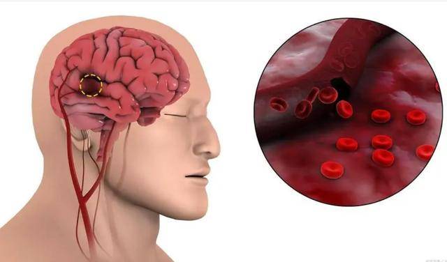 如何判斷自己是否腦供血不足——癥狀解析與應(yīng)對策略，腦供血不足的判斷方法，癥狀解析及應(yīng)對之策