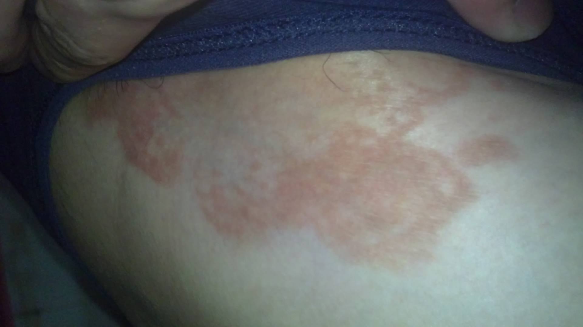 股癬最佳治療藥膏，了解并選擇最適合的藥膏，股癬最佳治療藥膏推薦，選擇最適合的藥膏治療股癬