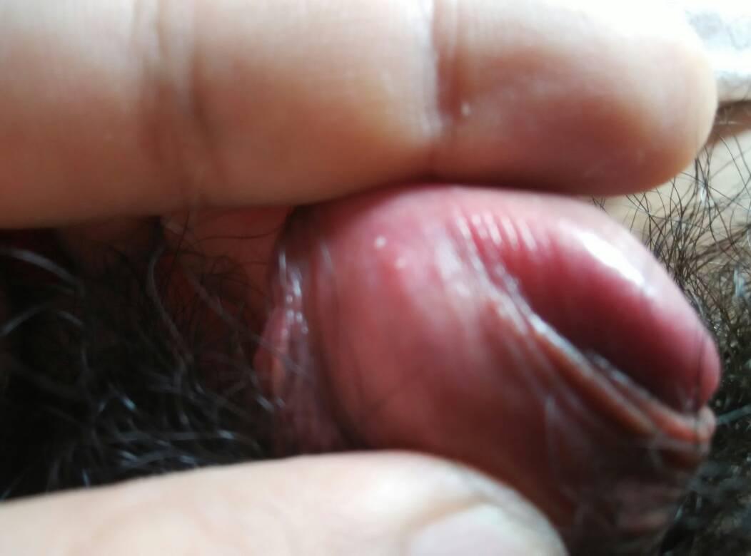 醋酸白疣體變白對照圖片，深入了解與識別，醋酸白疣體變白詳解，識別與對照圖片指南