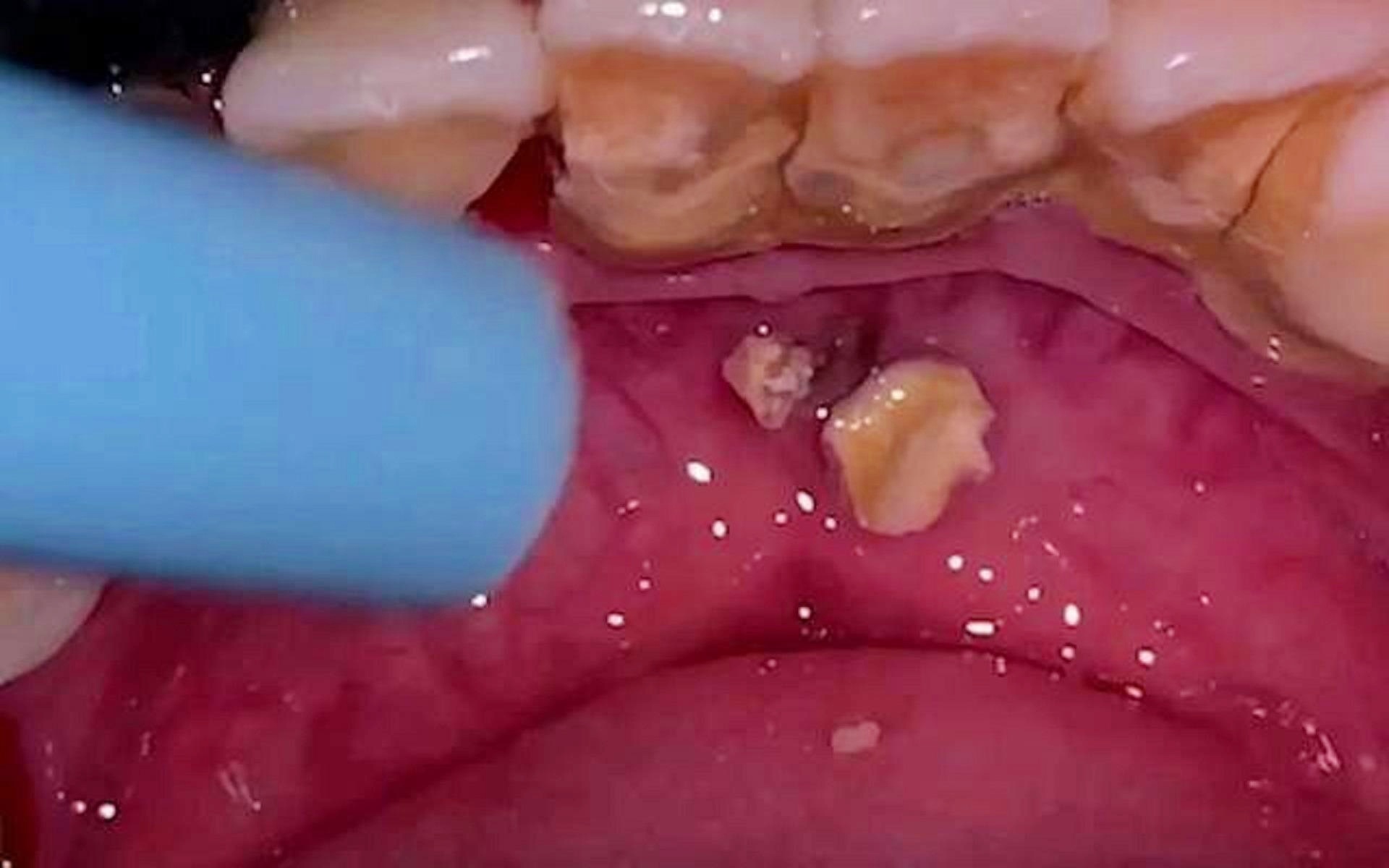 告別牙結(jié)石煩惱，5秒脫落牙結(jié)石的秘密與真相，揭秘，告別牙結(jié)石煩惱，只需5秒輕松脫落的秘密與真相！