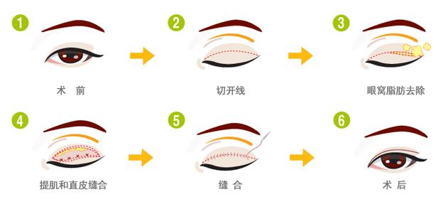 成都雙眼皮手術(shù)，尋找最優(yōu)秀的醫(yī)療機構(gòu)，成都雙眼皮手術(shù)最佳醫(yī)療機構(gòu)尋找指南