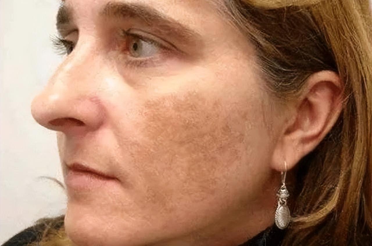 如何有效去除老年斑——全方位指南，全方位指南，如何有效去除老年斑