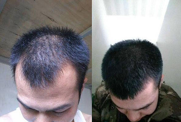 男生脫發(fā)嚴(yán)重怎么改善，男生脫發(fā)嚴(yán)重如何改善？有效方法大揭秘