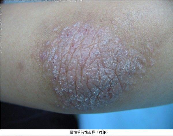 牛皮膚癬怎么根治，全面解析與有效治療策略，全面解析牛皮膚癬的根治方法與有效治療策略