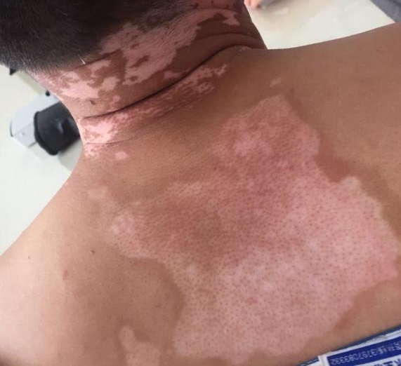 什么樣的白斑不用治——深入了解白斑的多種可能性，白斑的多種可能性解析，哪些白斑無需治療？