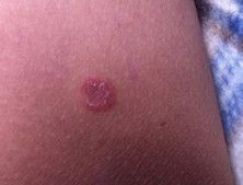 硬下疳，深入了解與應(yīng)對(duì)之道，硬下疳，全面解析與應(yīng)對(duì)策略