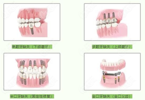種牙多少錢一顆牙價(jià)格表2023，全面解析種植牙費(fèi)用及影響因素，2023年種植牙價(jià)格表全面解析，費(fèi)用、影響因素一網(wǎng)打盡