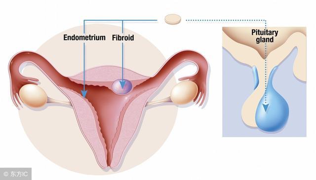 子宮肌瘤會自己消失嗎？解析子宮肌瘤的發(fā)展與消退可能性，子宮肌瘤的發(fā)展與消退可能性解析，能否自行消失？