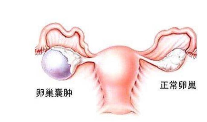卵巢囊腫的癥狀及應(yīng)對方法，卵巢囊腫的癥狀與應(yīng)對之策