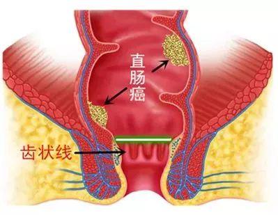 痔瘡長什么樣？圖片解析幫助你了解痔瘡癥狀，痔瘡詳解，圖片解析帶你了解痔瘡癥狀及表現(xiàn)