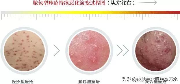 七種痘痘的種類圖解及其成因與防治策略，七種痘痘種類圖解，成因、防治策略全解析