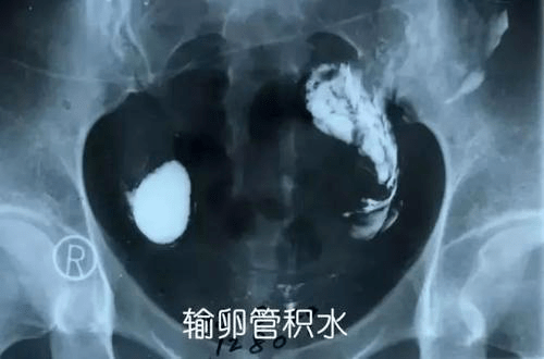 輸卵管造影費(fèi)用詳解，多少錢及大概價(jià)格范圍，輸卵管造影費(fèi)用解析，價(jià)格范圍及詳細(xì)費(fèi)用探討