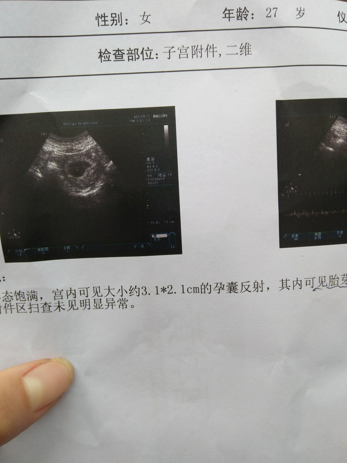 關(guān)于已生男孩孕囊圖片的探討，已生男孩的孕囊圖片深度探討