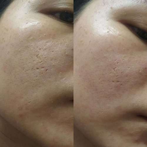 祛痘坑最好的方法，目前最有效的解決方案，最有效的祛痘坑方法，當(dāng)前最受歡迎的解決方案