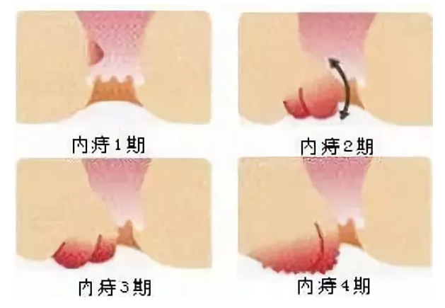 怎樣判斷自己是否患有痔瘡？全面解析與指導(dǎo)，如何判斷自己是否患有痔瘡？詳細(xì)解析及指導(dǎo)指南