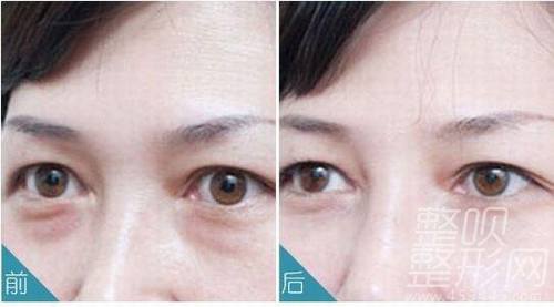 眼袋最好的根治方法，重塑明亮雙眼的秘訣，重塑明亮雙眼，眼袋根治秘訣揭曉