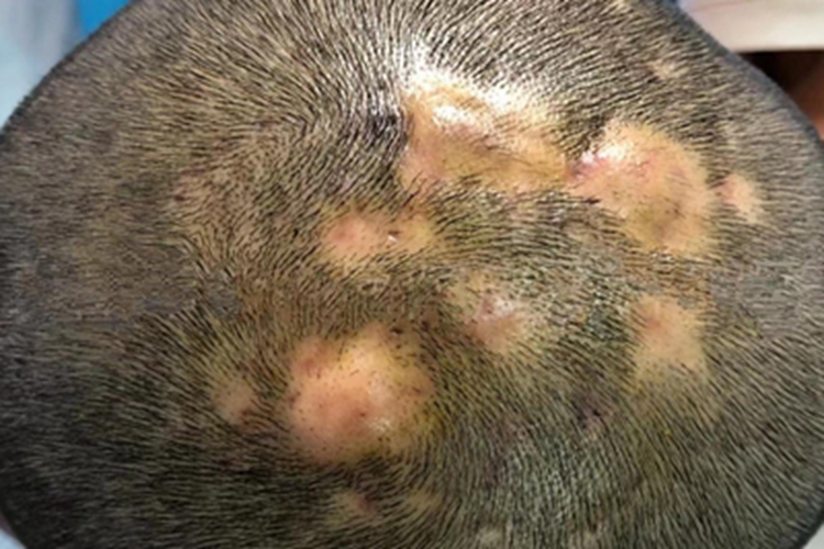 毛囊炎硬疙瘩圖片，了解、識(shí)別與治療，毛囊炎硬疙瘩詳解，識(shí)別圖片、了解與治療