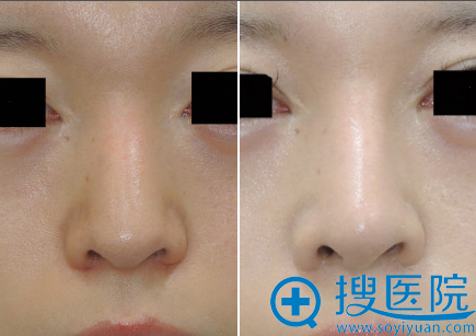 鼻子整容需要多少費用，全面解析費用因素與影響因素，鼻子整容費用全面解析，費用因素與影響因素探討