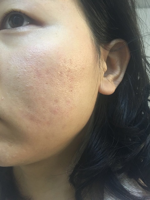 嚴(yán)重痤瘡治療最徹底的方法，全面攻略與最佳實(shí)踐，全面攻略揭秘，最徹底治療嚴(yán)重痤瘡的最佳實(shí)踐與最佳方法