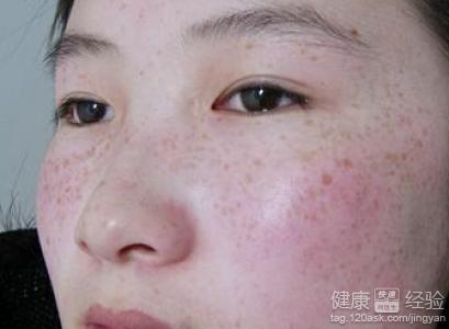 怎樣去除黃褐斑最快最有效，全面解析黃褐斑的成因與有效治療方法，全面解析黃褐斑成因及快速有效的去除方法