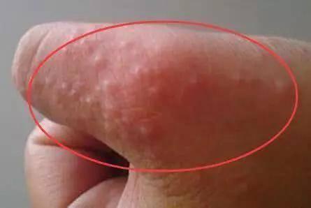 生殖上長(zhǎng)小水泡的原因，深度解析與應(yīng)對(duì)建議，生殖部位小水泡成因深度解析及應(yīng)對(duì)建議