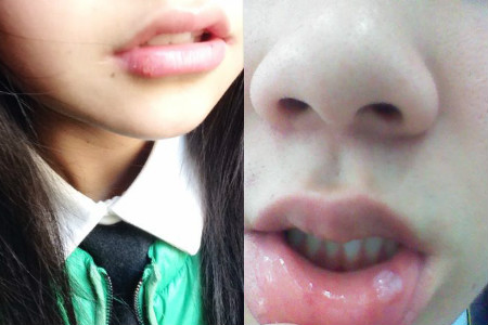 唇上長(zhǎng)水泡如何快速消除，原因、治療與預(yù)防，唇上長(zhǎng)水泡，快速消除、原因分析及治療與預(yù)防方法